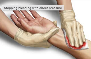 Using pressure on a bleeding wound.