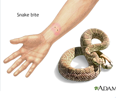 Snake Bites and how to deal with them.